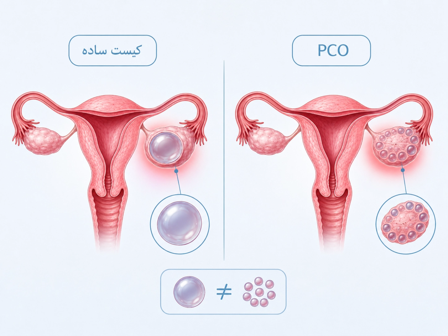 تفاوت علائم کیست ساده تخمدان و PCOS چیست؟