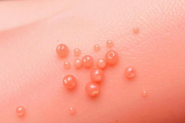 زگیل تناسلی چیست؟