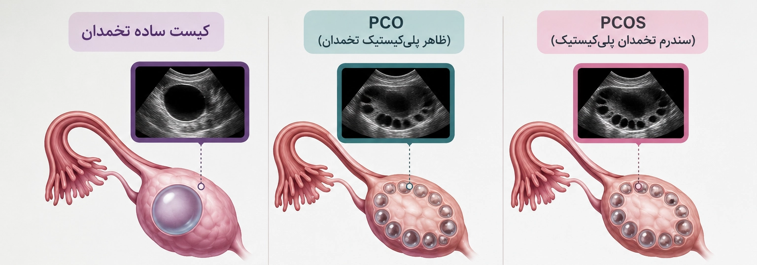 کیست تخمدان، PCO یا PCOS؛ چگونه تفاوت آن‌ها مشخص می‌شود؟