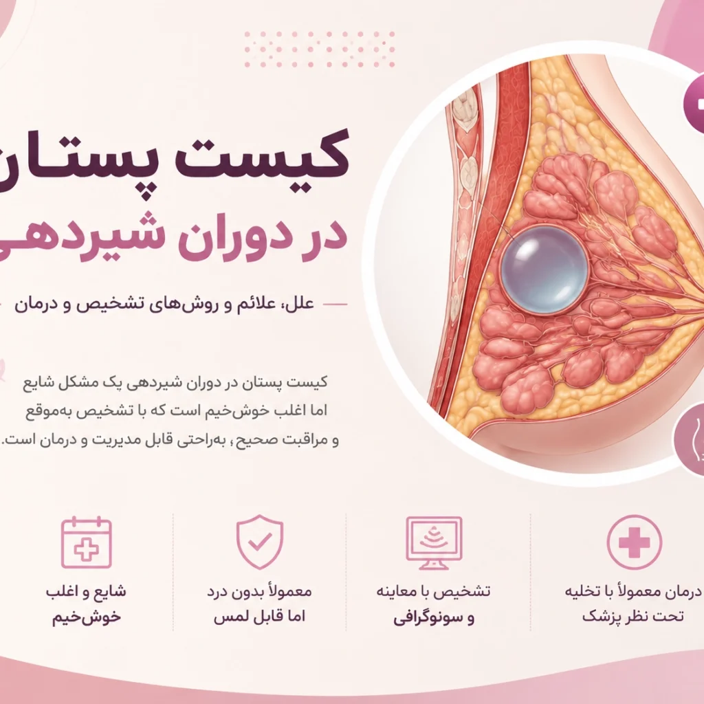 کیست پستان در دوران شیردهی چیست؟