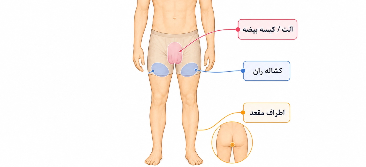 علائم زگیل تناسلی در مردان چیست؟